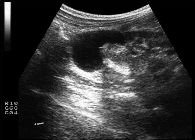 Гематома почки на узи