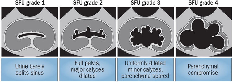 Схематическое отображение степеней Гидронефроза на УЗИ согласно SFU
