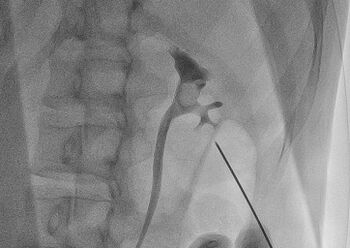 Введение инструментов в почку под контролем рентгеновских лучей