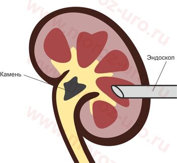 Схема введения эндоскопа в почку