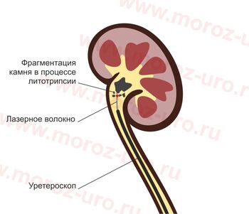 Дробление камня почки с помощью уретерореноскопии