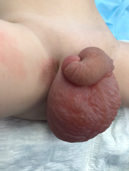 лимфангиома наружных половых органов, ребёнок 2 года