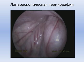 Операция паховых грыж в морозовской больнице