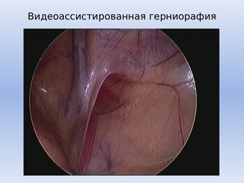 Паховая грыжа у детей детская больница