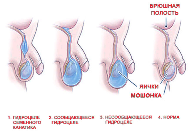 Водянка оболочек яичка