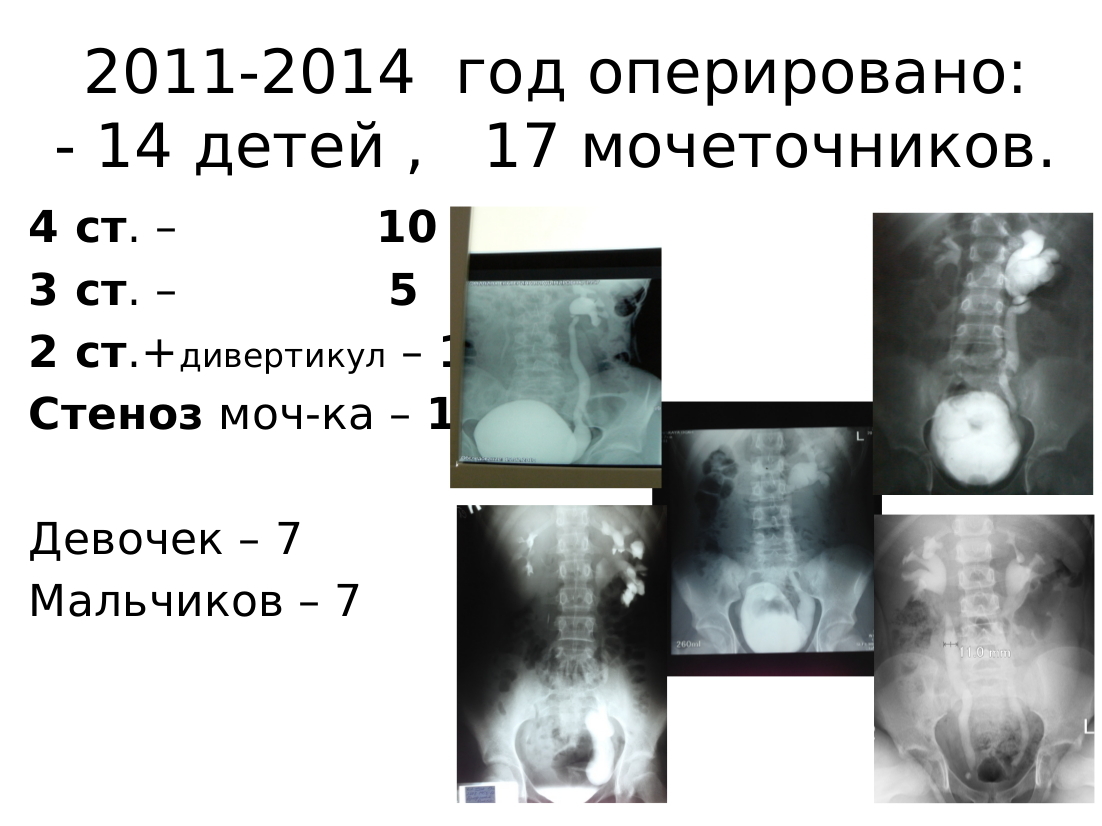 Рефлюкс у детей. Пузырно-мочеточниковый рефлюкс УЗИ. Пузырно-мочеточниковый рефлюкс на УЗИ У детей. Рефлюкс на УЗИ. Пузырно-мочеточниковый рефлюкс у детей презентация УЗИ.