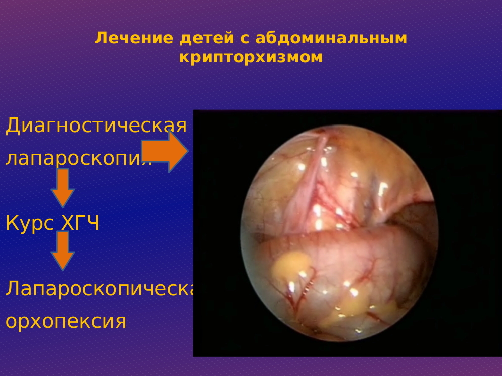 Доклад: Крипторхизм